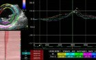 Dyskinetic Anterior Left Ventricular Wall