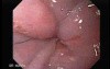 Endoscopic Ablation Of Barrett's Esophagus - Follow-Up After 6 Months