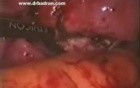 Laparoscopic Hysterectomy