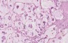 Colloid carcinoma - Histopathology - Breast