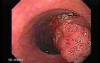 Tubulo-Villous Adenoma (1 of 6)