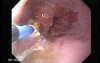 Endoscopic Ablation Of Barrett's Esophagus - 1/6