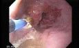 Endoscopic Ablation Of Barrett's Esophagus - 1/6