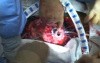 Implantation of a Left Ventricular Assist Device (Heartmate II LVAD)