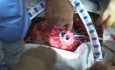 Implantation of a Left Ventricular Assist Device (Heartmate II LVAD)