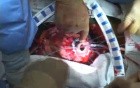 Implantation of a Left Ventricular Assist Device (Heartmate II LVAD)
