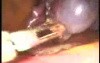 Laparoscopic Left Adnexectomy On Ovarian Teratoma