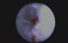 Removal Of Enamel Projection