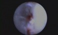 Removal Of Enamel Projection