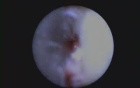 Removal Of Enamel Projection