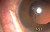 Post Vitrectomy & Lensectomy Site - Transciliary Filtration