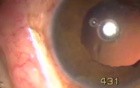 Post Vitrectomy & Lensectomy Site - Transciliary Filtration