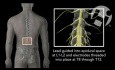 Lumbar - Spinal Cord Stimulator Placement