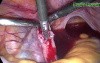 Ectopic Pregnancy - Salpingectomy by Use of Laparoscopic Surgery