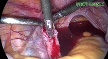 Ectopic Pregnancy - Salpingectomy by Use of Laparoscopic Surgery
