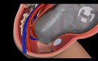 Cord Prolapse