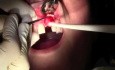 Flap Design & Pilot Hole - Implant Placement #9
