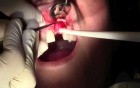 Flap Design & Pilot Hole - Implant Placement #9