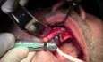 Implant Surgery, #5-6-7 Sites