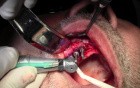 Implant Surgery, #5-6-7 Sites