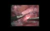 Urinary Bladder Injury Due To The Trauma Of Lower Abdomen And Groin Region