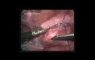 Urinary Bladder Injury Due To The Trauma Of Lower Abdomen And Groin Region