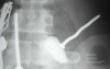 Multiple Foreign bodies in the GI tract (10 of 12)