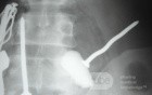 Multiple Foreign bodies in the GI tract (10 of 12)