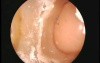 SIMONT skull base surgery