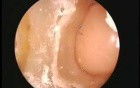 SIMONT skull base surgery