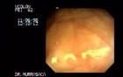 Amebic Colitis 2