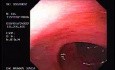 Rectal Bleeding (1 of 2)