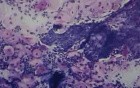 Cervicitis - Fibrin
