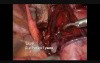Right Inguinal Hernia Repair - TAPP