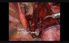 Right Inguinal Hernia Repair - TAPP