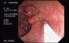 Tubulo - Villous Adenoma - Endoscopy (20 of 28)