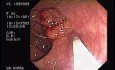 Tubulo - Villous Adenoma - Endoscopy (20 of 28)