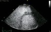 Right Ventriculus Study