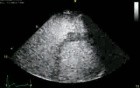 Right Ventriculus Study