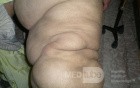 Leg Swelling