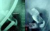 EUS-guided Biliary Drainage