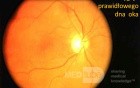 Normal Fundus Of The Right Eye