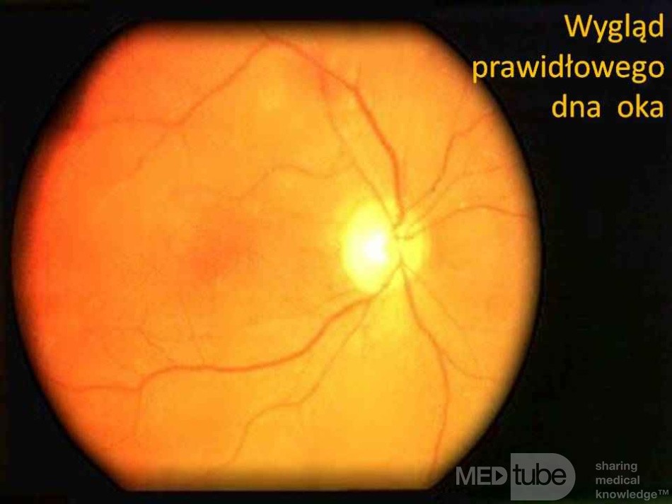 Normal Fundus Of The Right Eye