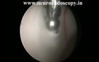 Endoscopic Septostomy