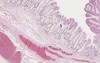 Tubular adenoma (adenomatous polyp) - Histopathology - Colon