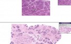 Breast - Hyperplasia Of Lactation