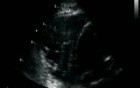 Right Ventriculus Study