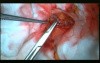 Open Right Hemicolectomy – Technical Principles - Operation No 1 - Part 4