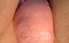 HUGE CHRONIC VAULT PROLAPSE