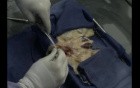 Kidneys Dissection Before Pulsatile Machine Perfusion On Waters Medical Systems With RM3